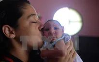 Brazil phát hiện virus Zika trong não của trẻ bị bệnh đầu nhỏ