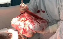 Bóc tách thành công khối u buồng trứng nặng 35 kg