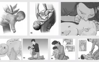 Cách sơ cứu dị vật đường thở trước khi đến cơ sở y tế