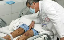 Viêm não mô cầu lây qua đường hô hấp có nguy cơ tử vong cao
