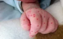 Đăk Lăk: Bé gái 4 tháng tuổi tử vong do nghi viêm màng não mô cầu