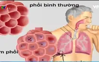 Phòng bệnh viêm phổi ở người cao tuổi
