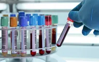 Ứng dụng kỹ thuật phân tử trong xét nghiệm máu sàng lọc virus