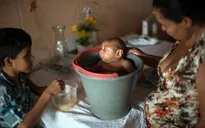 Nguy cơ trẻ bị dị tật đầu nhỏ lớn nếu mẹ nhiễm virus Zika trong 3 tháng đầu thai kỳ