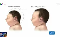 Florida (Mỹ) xác nhận sản phụ đầu tiên nhiễm Zika sinh con đầu nhỏ