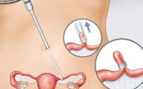 Khi nào nên triệt sản đối với nữ?