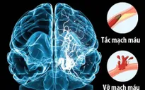 Tìm hiểu về căn bệnh đột quỵ gây nguy hiểm tính mạng