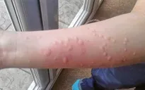 Phòng và điều trị bệnh ngoài da do nhiễm virus