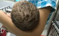 Bé trai nhiễm độc da toàn thân do được mẹ tắm lá chữa thủy đậu