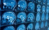 Trí tuệ nhân tạo dự đoán bệnh Alzheimer sớm trước 10 năm