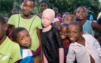 Người mắc bạch tạng ở Malawi có nguy cơ tuyệt chủng