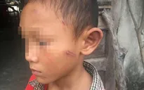 Điều tra nguyên nhân cháu bé bị bạo hành ở Quảng Ngãi