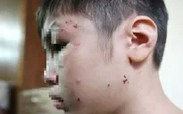Đề nghị khởi tố vụ bé trai 10 tuổi bị bạo hành