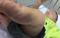 Hà Nội: Điều tra vụ bé trai 1 tuổi nghi bị bạo hành nghiêm trọng
