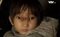 Bé gái có khối u lớn trên mặt khát khao được phẫu thuật