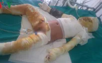 Bé trai 6 tuổi bị bỏng cồn toàn thân rất cần sự chia sẻ, giúp đỡ