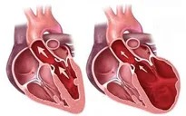 Bệnh lý cơ giãn tim có tỷ lệ tử vong cao
