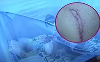 Điều tra vụ bé trai 2 tuổi có vết thương quanh hậu môn