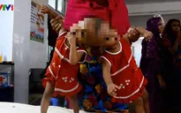 Cặp song sinh chào đời dính liền đầu tại Bangladesh
