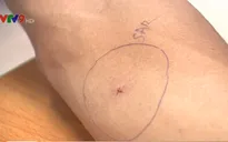 Cảnh báo bệnh dại gia tăng mùa nắng nóng