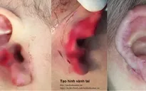 Hà Nội: Bé trai 18 tháng tuổi bị chó nhà hàng xóm cắn nát tai