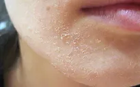 Lạm dụng corticoid, da bạn phải đối diện vấn đề gì?