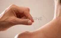 Châm cứu - Phương pháp chữa bệnh ngày càng được ưa chuộng