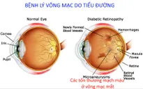 Tìm hiểu bệnh võng mạc do đái tháo đường