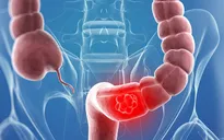 Điều trị bệnh đại tràng hiệu quả với Đông dược