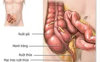Bệnh viêm đại tràng co thắt dễ tái phát