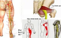 Các biện pháp chữa đau lưng, đau thần kinh tọa do thoát vị đĩa đệm