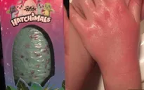 Đồ chơi “quả trứng thần kỳ” Hatchimals có thể gây bỏng cho trẻ