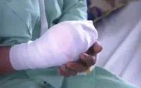 Cấp cứu trường hợp bị máy xay thịt cuốn vào tay