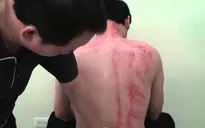 Không đánh gió, nặn máu khi bị đột quỵ