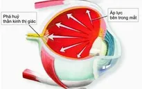 Dấu hiệu nhận biết và phương pháp điều trị bệnh glocom