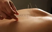 Châm cứu trở thành môn học chính tại trường đại học