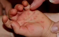 Dấu hiệu và cách phòng ngừa bệnh tay chân miệng