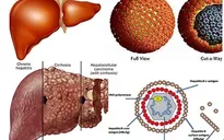 Viêm gan C - Căn bệnh thầm lặng để lại hậu quả nặng nề