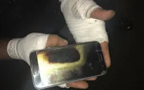 Bị bỏng nặng vì Galaxy S7 phát nổ trên tay