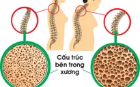 Hướng dẫn chế độ dinh dưỡng cải thiện bệnh loãng xương