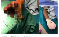 Sơn La: Bé 8 tuổi dập nát tay vì pin điện thoại phát nổ