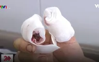 Nối liền thành công ngón tay bị máy xay thịt làm đứt lìa