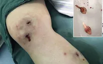 Kinh hãi nhìn giòi bò lổm ngổm trong chân phượt thủ Trung Quốc