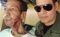 Từ một vết loét miệng, người đàn ông này đã bị "ăn" mất gần nửa khuôn mặt