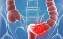 Những dạng ung thư không phải là án tử hình của cuộc đời