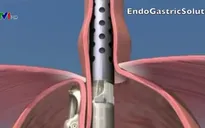 Phương pháp mới điều trị bệnh ợ nóng