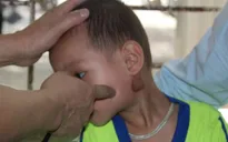 Khánh Hòa gia tăng số ca mắc quai bị