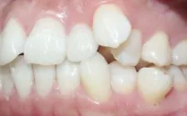 Cách điều trị răng xô lệch tận gốc