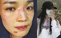 Thư Kỳ bị dị ứng da mặt nghiêm trọng