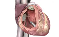 Mỹ: Cấy ghép máy tạo nhịp tim nhỏ nhất thế giới